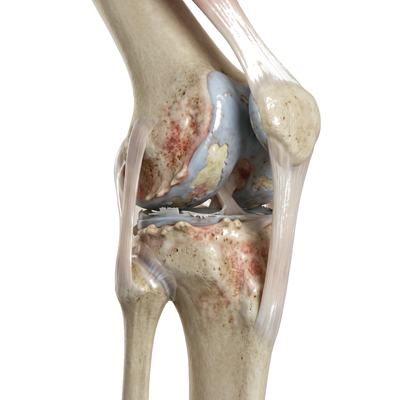 Damaged Arthritic Knee 3D Model