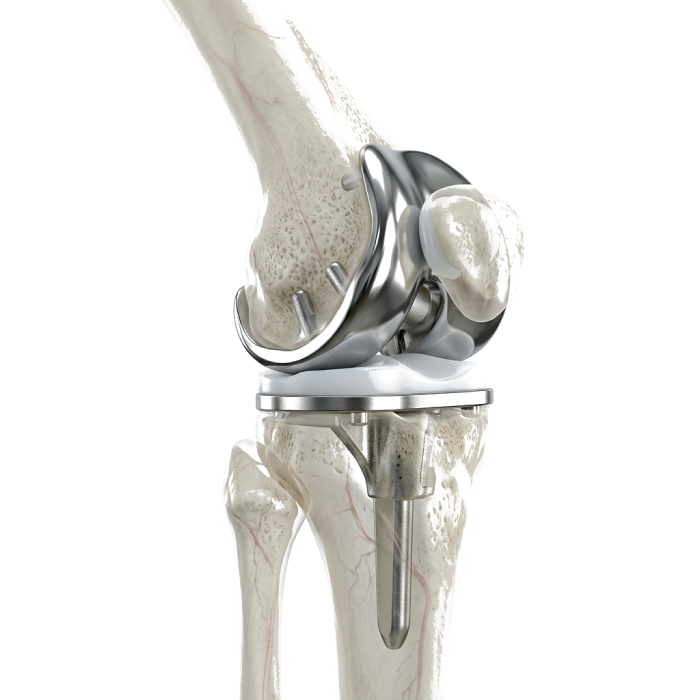 Robotic-Assisted Knee Replacement 3D Model